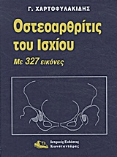 Εικόνα της Οστεοαρθρίτις του ισχίου